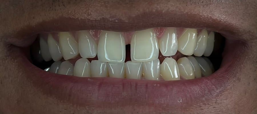 Fechamento de diastema — antes