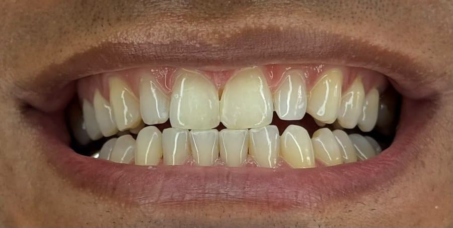 Fechamento de diastema — depois