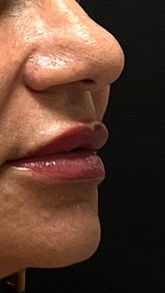 Preenchimento labial — contorno e hidratação — depois