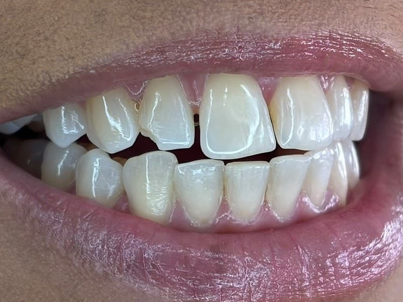 Restauração de ângulo incisal — antes
